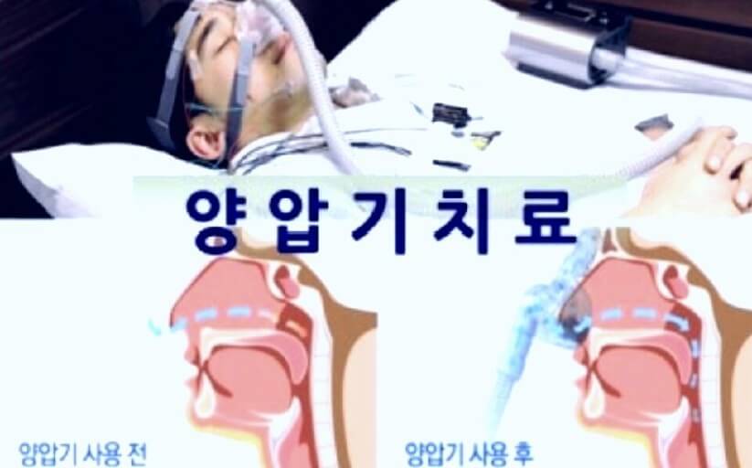 수면 무호흡증 치료
