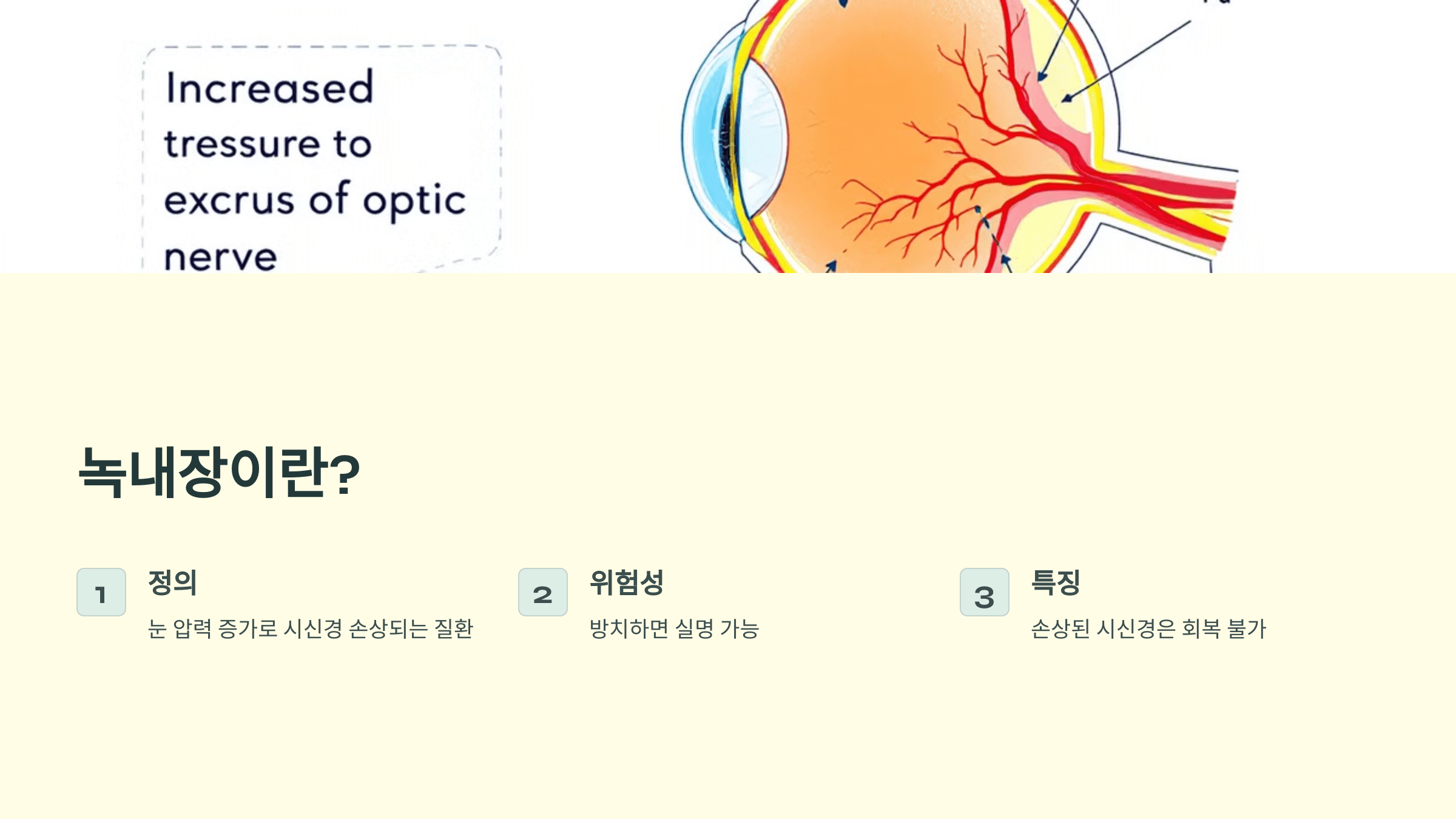 녹내장과 관련된 사진입니다.