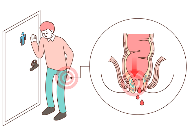 치질 치루 치핵 치열