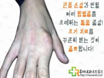 손등 붓는 이유 혈액순환 문제 증상과 해결법 정리_2