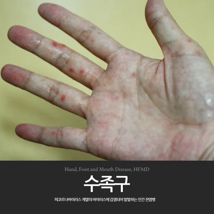 수족구 어른 전염에 대한 원인과 예방법 정리_7