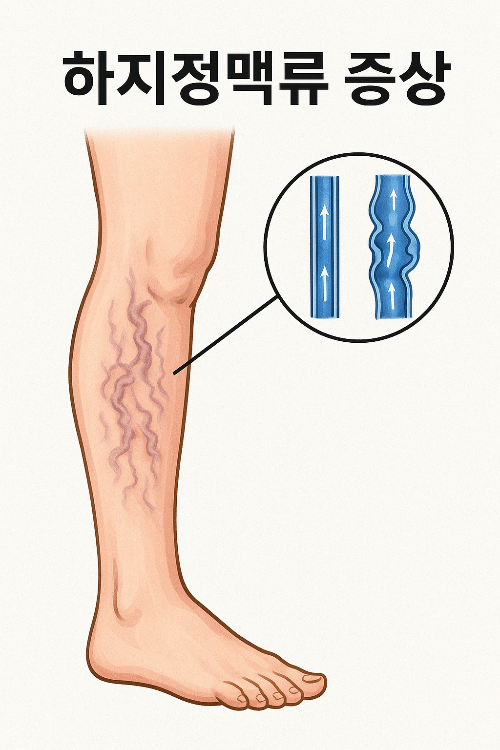하지정맥류 다리 혈관 증상