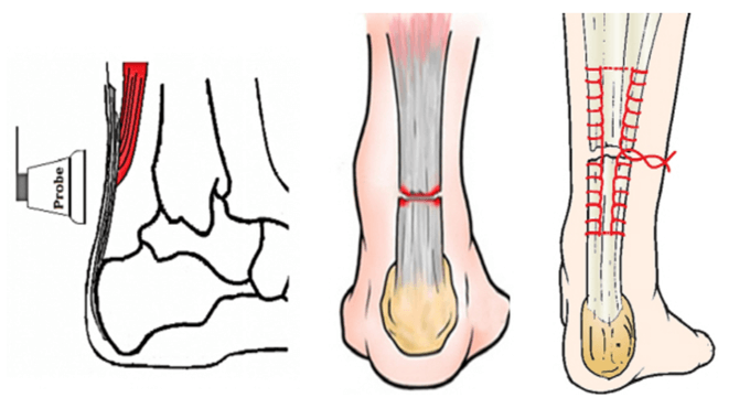 파열된 아킬레스건을 재건하는 수술 방법을 나타낸 그림