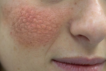 루프스 병 (systemic lupus erythematosus), 전신성 홍반성 원인과 증상에 대해 알아봤습니다. 매우 생소한 이름인데요. 얼굴에 나비 모양으로 발진이 일어났다면 한번쯤은 의심해봐야 합니다. 루프스 병은 어디 병원으로 가야 하는지와 치료방법까지 천천히 읽어 보시기 바랍니다.