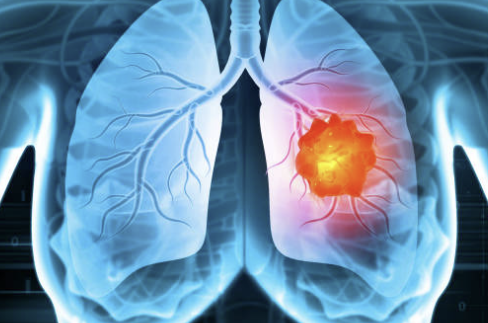 폐암 초기증상, 폐암에 좋은 음식 알아보기!