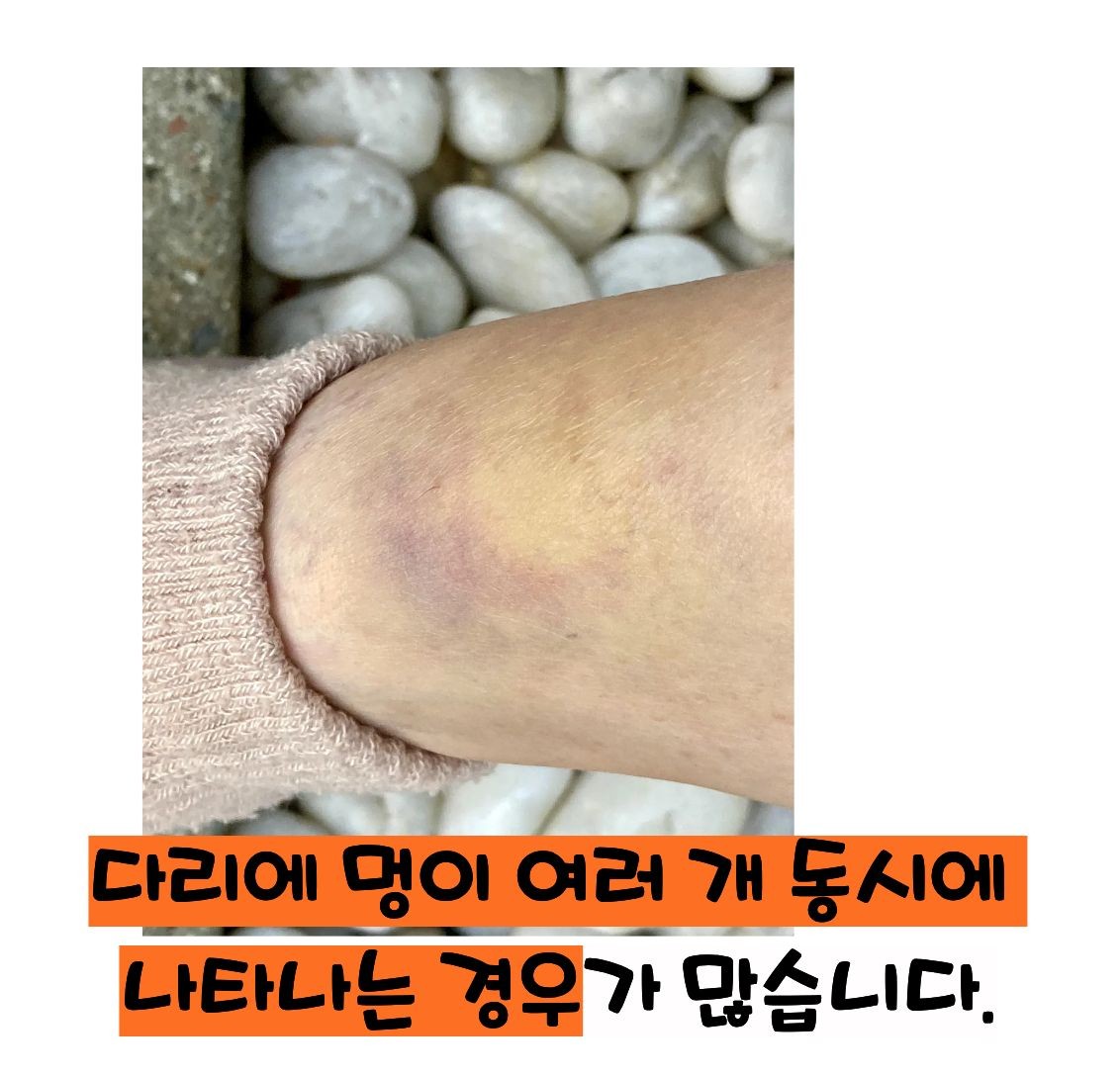 혈소판 감소증 증상