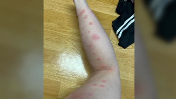 빈대에 물린 자국 사진