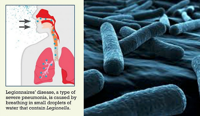 레지오넬라증 증상과 원인&amp;#44; 치료법