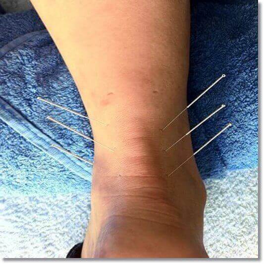 아킬레스건염 치료, 침술 치료하는 아킬레스건염 환자