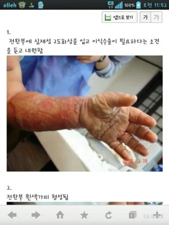 2도 화상 증상 자가치료 회복기간 응급처치법 정리_18