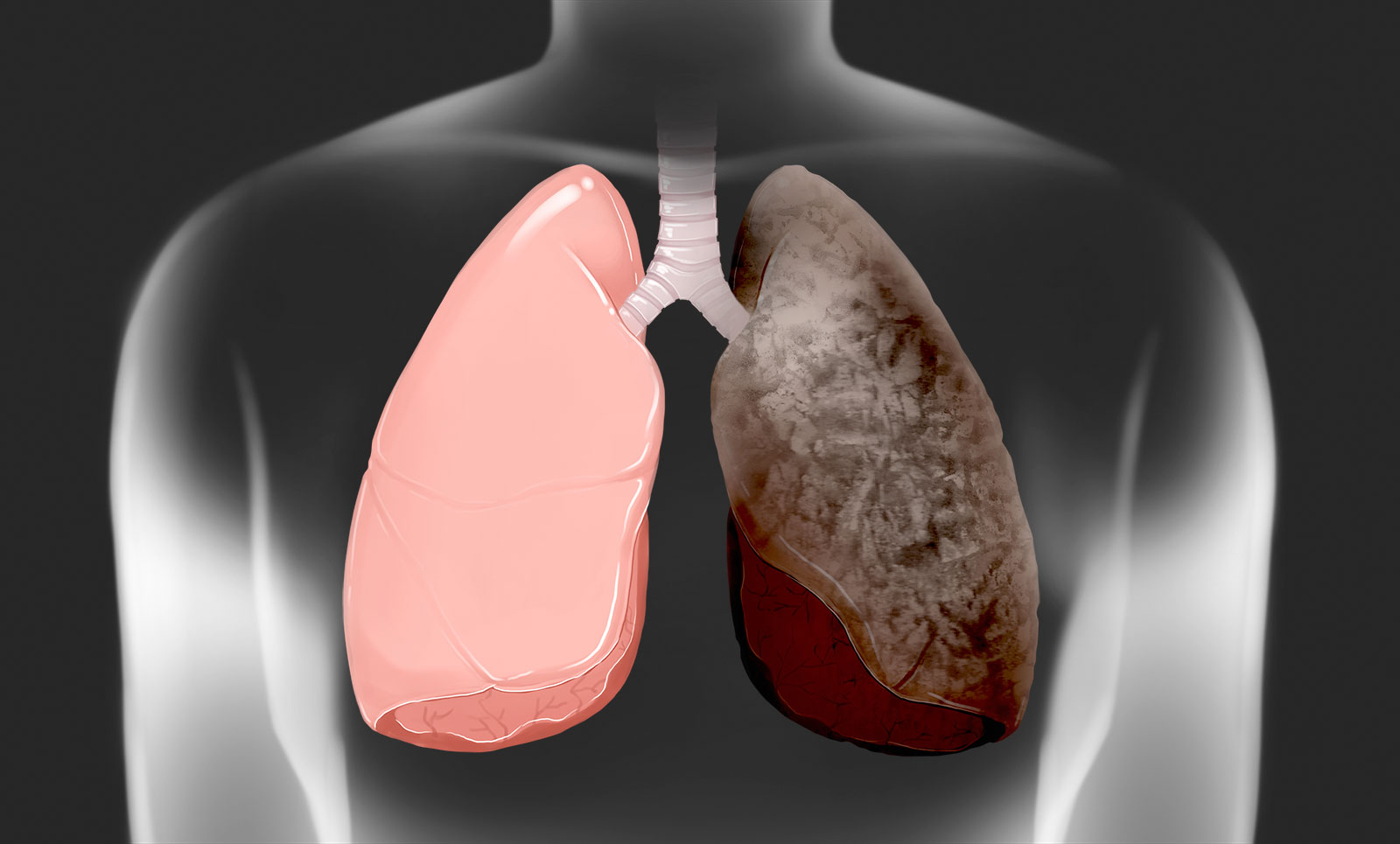 건강한 폐와 암에 걸린 폐를 가진 사람의 이미지