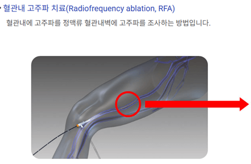 다리가-붓는-이유-하지정맥류-수술비용