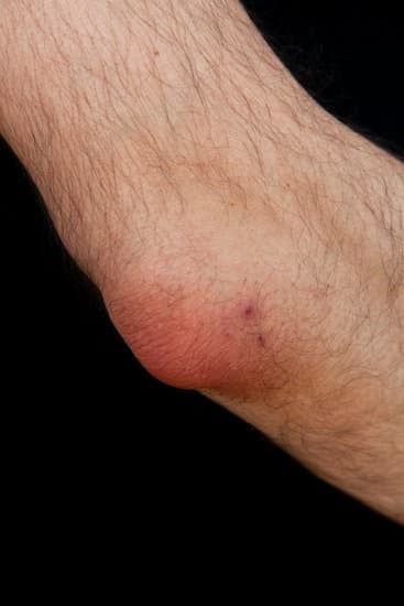 팔꿈치 윤활낭염(Bursitis): 원인, 증상, 치료 및 관리