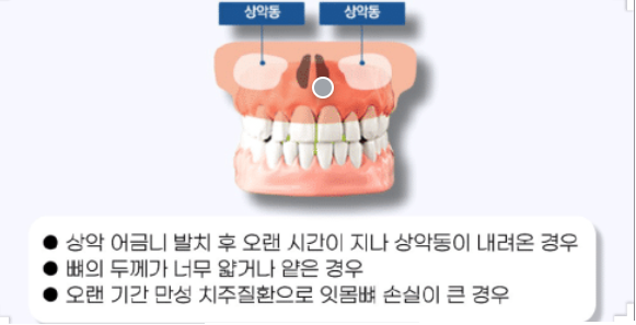 임플란트 부작용