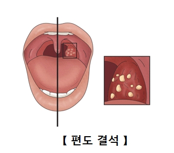 편도 결석 출처 서울 아산 병원 홈페이지