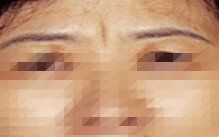 미간-근육으로-인한-미간-주름