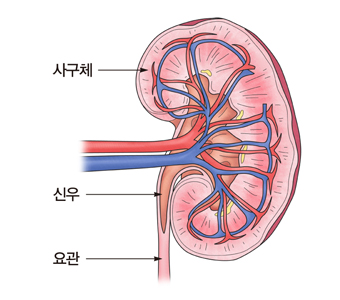 사구체신염 출처 서울 아산 병원 홈페이지