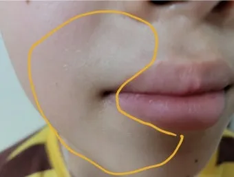 얼굴 버짐 증상 없애는 실전 방법 5가지 및 관리요령_19
