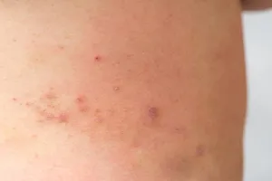 검버섯-없애는-방법