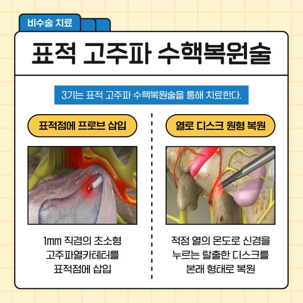 목견인기 원리 경추 견인 효과