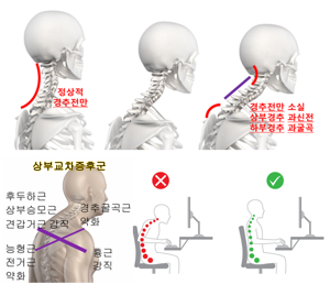 새끼 손가락 저림