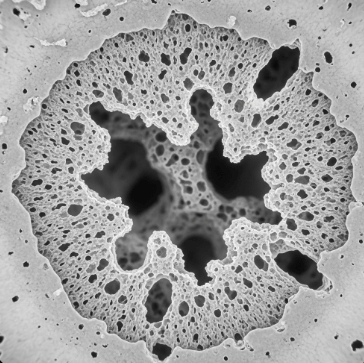 골감소증과 골다공증 차이점9