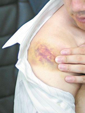 몸에 멍이 잘드는 이유