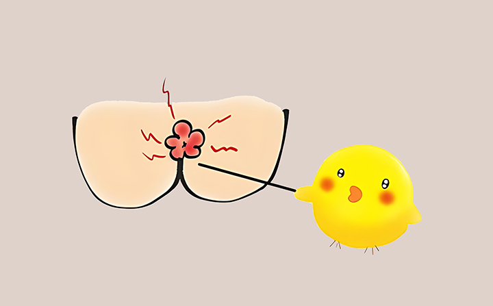 항문-주변의-사마귀