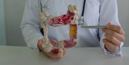 맹장염 관련 사진