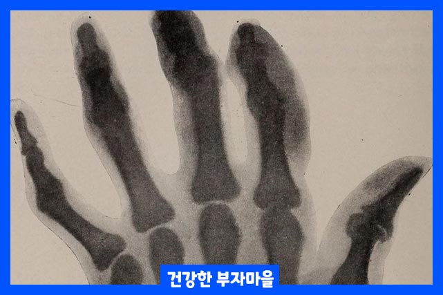 원인, 요산 수치 증가 때문