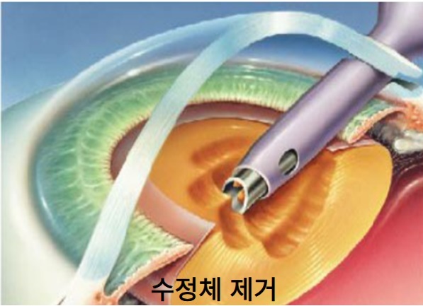 백내장 수술 방법-수정체 제거 모습