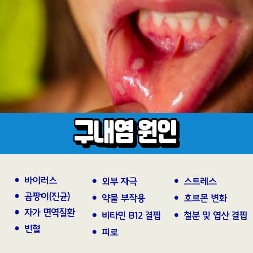 구내염_원인