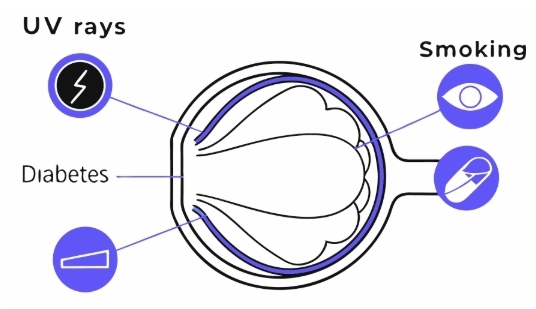 백내장 원인과 의심증상