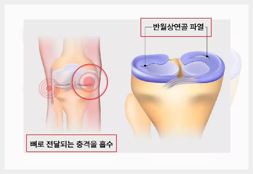 원판형 반월상연골