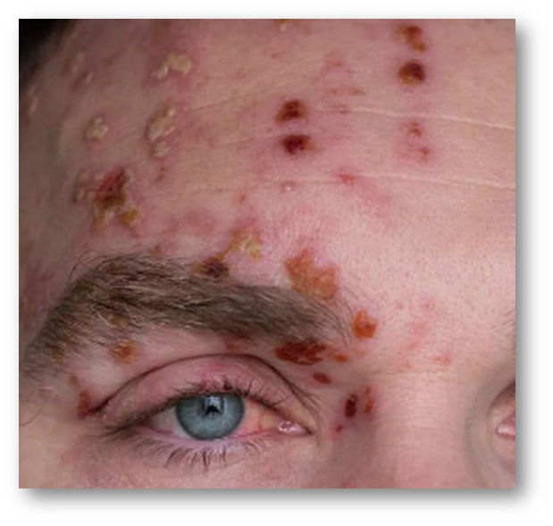  대상포진 초기증상4