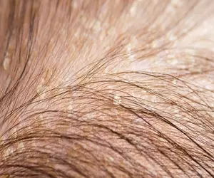 두피 가려움증 원인