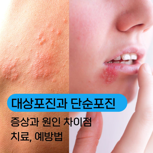 대상포진의 증상 및 원인