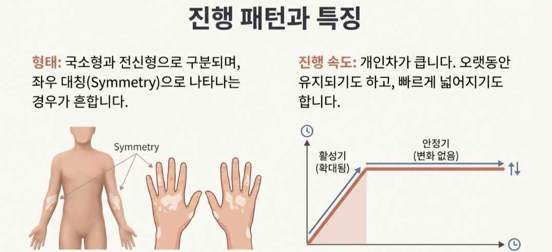 백반증원인-사진6