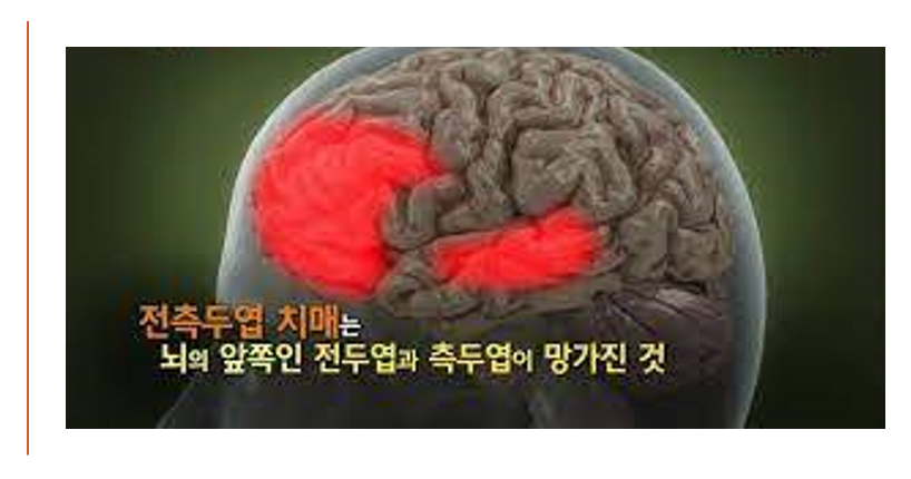 전측두엽치매