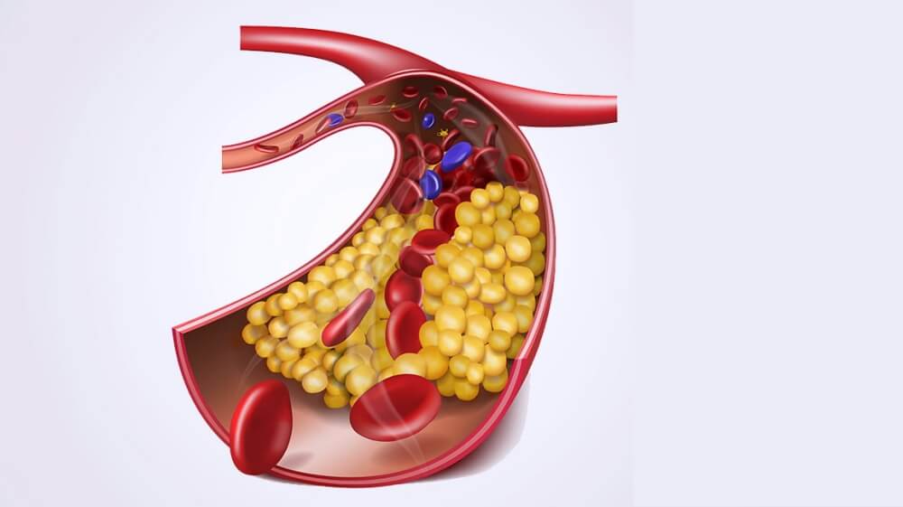 혈관에 콜레스테롤이 쌓여 있는 모습