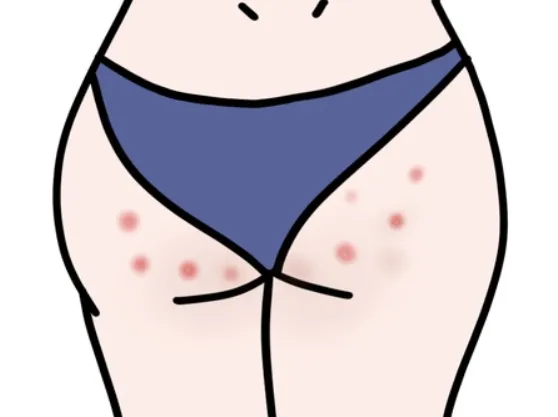 엉덩이 종기 없애는법