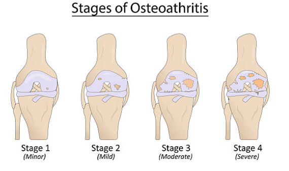 관절염의 4단계 진행 과정