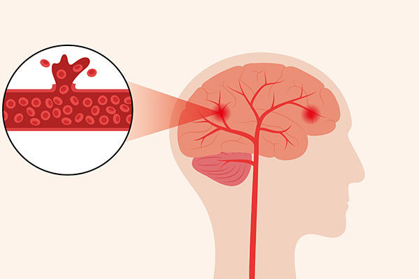 모야모야병의 증상과 원인