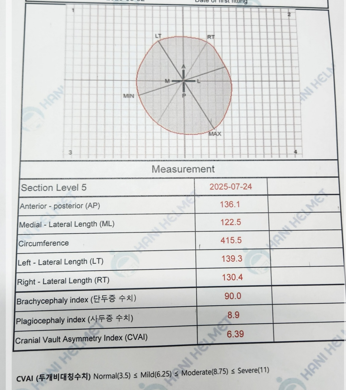 사두증 3D 진단결과