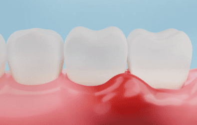 잇몸 염증 치료약