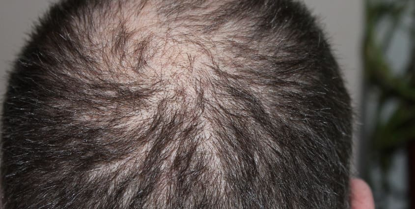 탈모가 생기고 있는 뒷머리