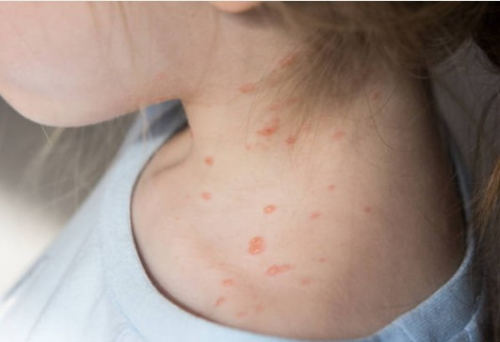 아기 어린이 수두 초기증상 발진 잠복기간 예방접종 시기