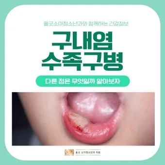 수족구병 증상과 예방 조치 방법 모음_21