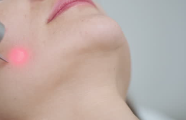 기미 레이저 치료