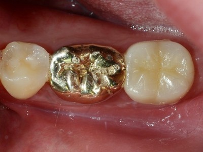 치과 크라운 종류